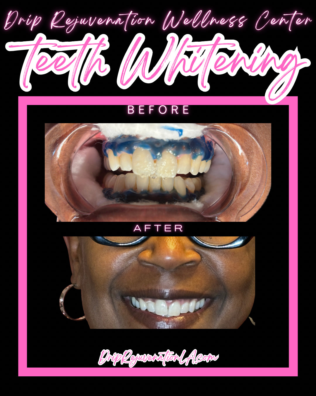 Too Sexy Smiles: Teeth Whitening